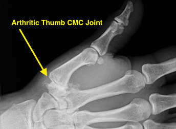 OSTEOARTHRITIS CARPOMETACARPAL CMC JOINT OF THUMB Hand Surgery Resource